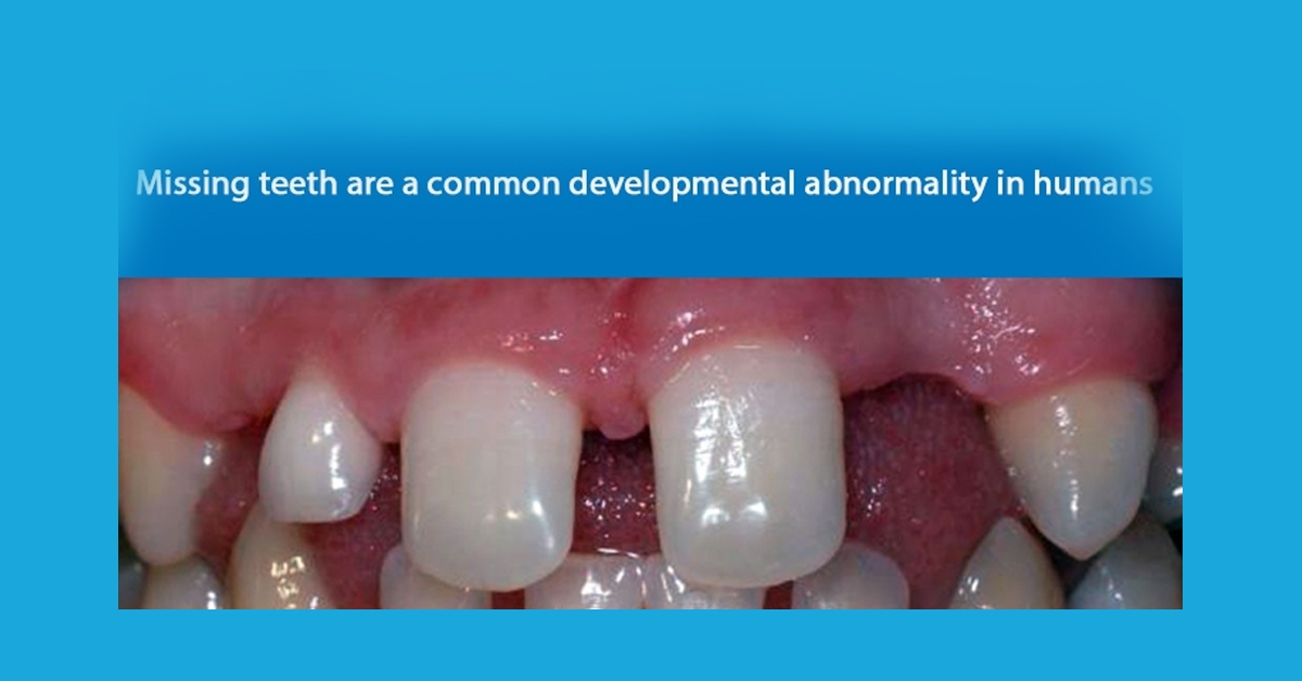 Early functional, esthetic, and psychological rehabilitation of preschool child with nonsyndromic oligodontia and anodontia in mixed dentition stage through conservative systematic approach: A case report with 5-year follow-up